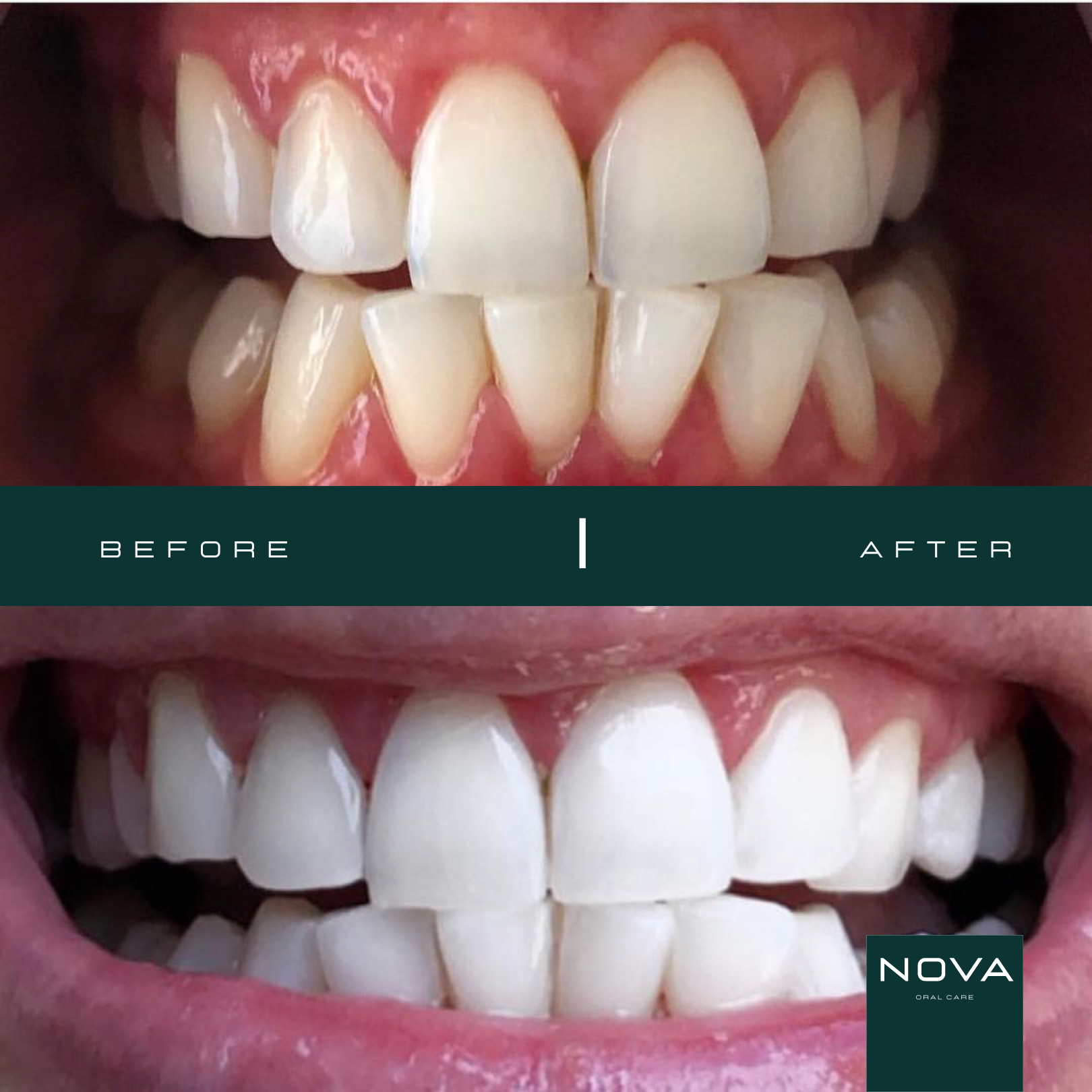Original Led Dental Bleaching Kit