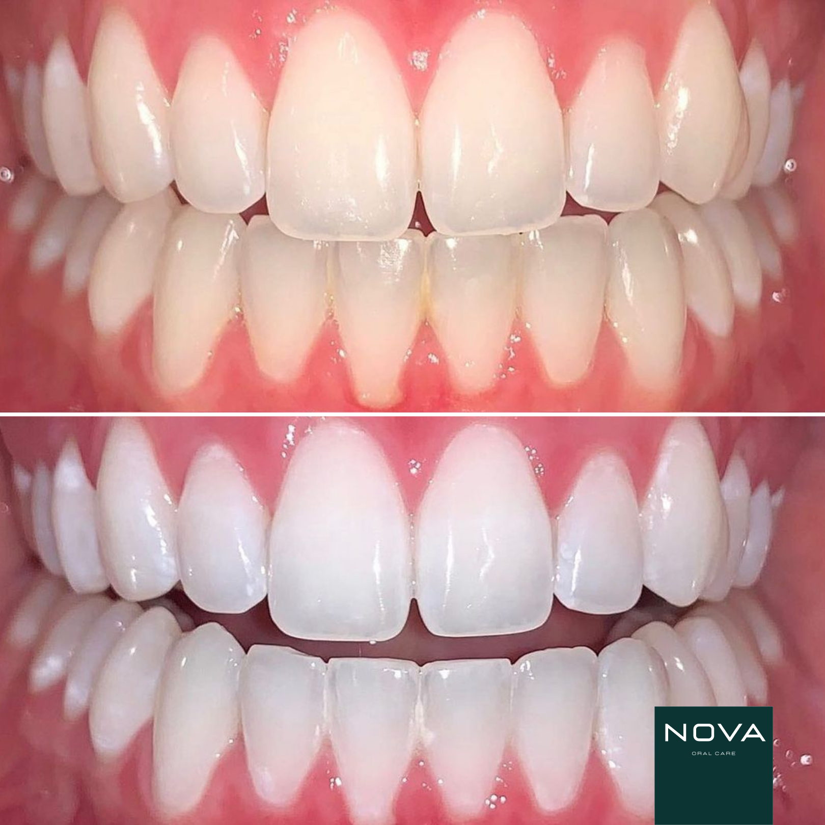 Original Led Dental Bleaching Kit